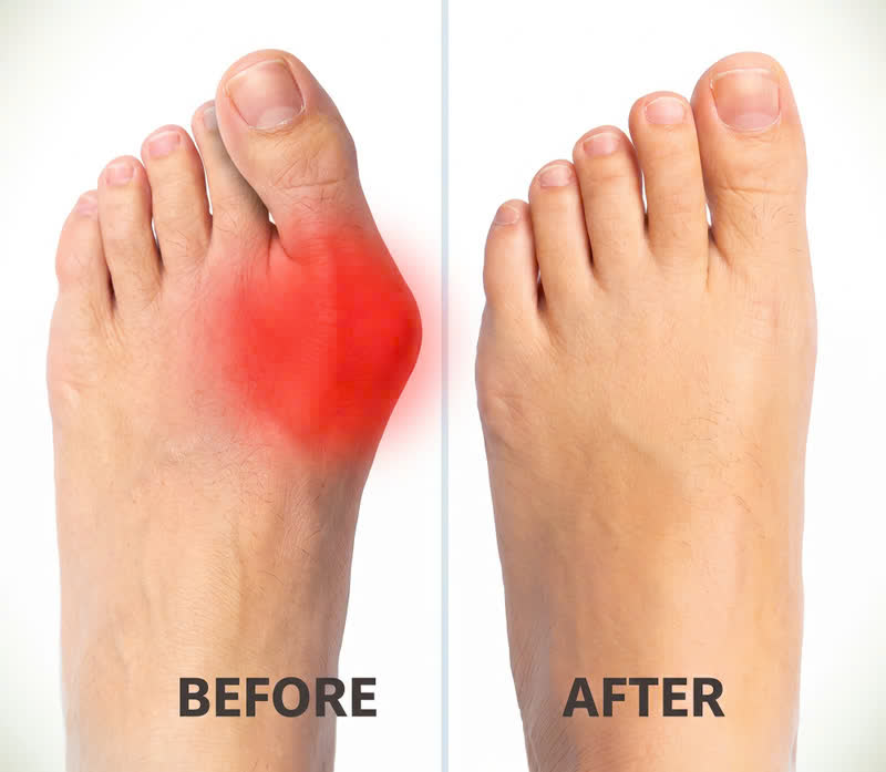 Before and after bunion alignment illustration